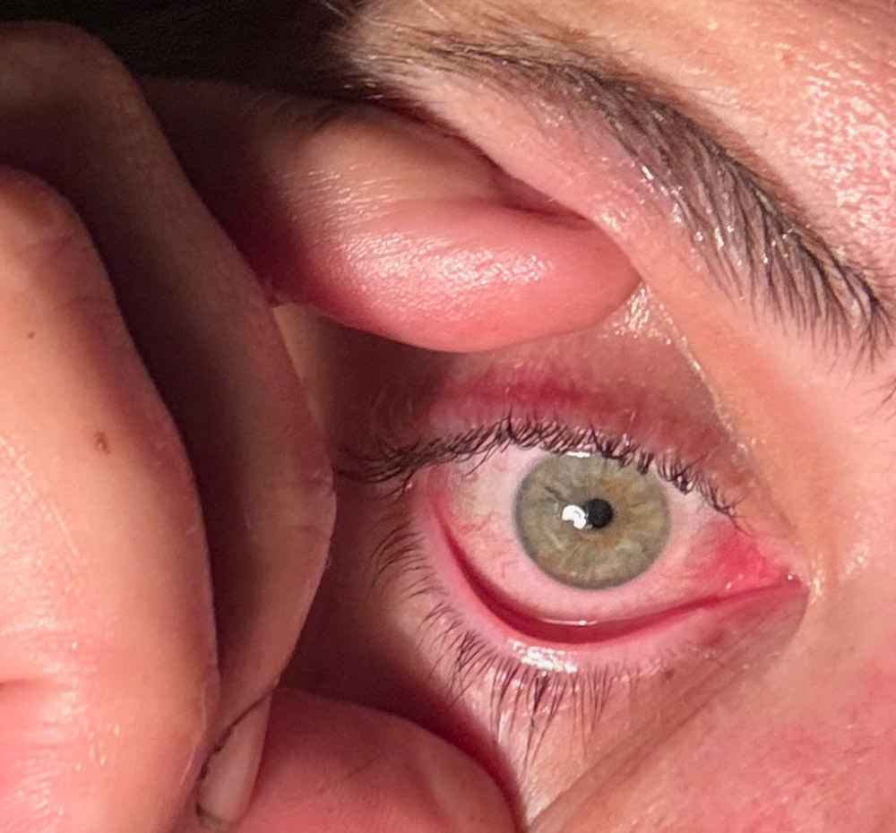 Close-up of irritated green eye with red sclera from a barnacle-related injury.